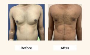 Gynecomastia in Gurgaon