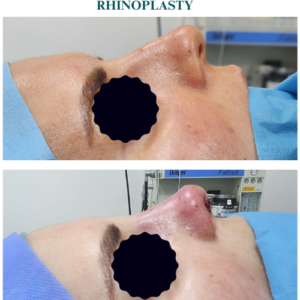 RHINOPLASTY