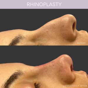 Rhinoplasty Before and After