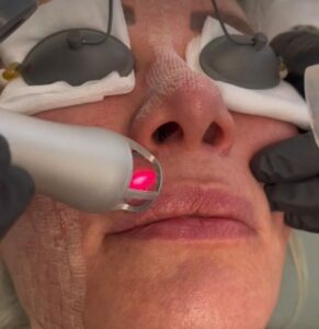 5 Benefits of CO2 Laser Resurfacing at Bryn Mawr Dermatology