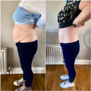Amazing Coolsculpting before & after photos 🔥 huge inch loss 🔥 #coolsculpting #cool #icetherapy…