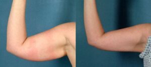 Arm Lift (Brachioplasty)_ All you need to know