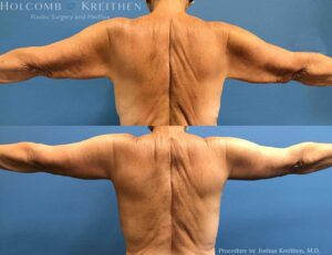 Armlift in Sarasota with Dr_ Kreithen