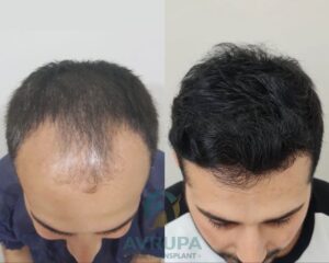 Before and After Hair Transplant in Turkey _ Sapphire FUE Technique