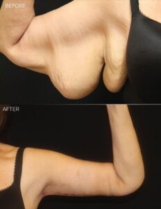 Brachioplasty Before & After Photos in Fort Worth, TX — West Magnolia Plastic Surgery