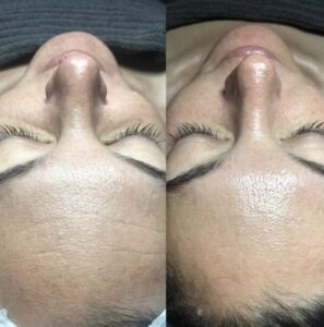 HYDRAFACIAL MD® – Body Clinic Day Spa (1)