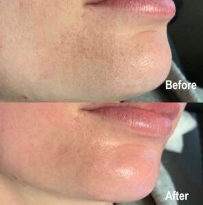 Hydrafacial Before and After pics