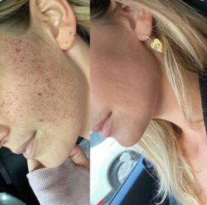 IPL solution to long Hyperpigmentation