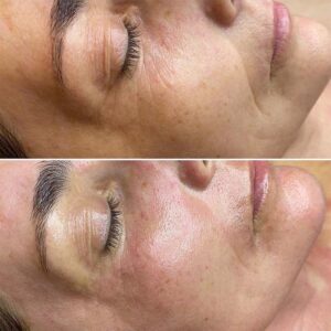 Microneedling Before and After 1 Treatment - What Can 1 Session Do_