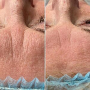 Microneedling Benefits - Why It's a Great Treatment