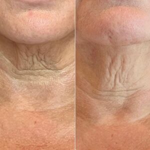 RF Microneedling - What Is It & What Are the Benefits_ (1)