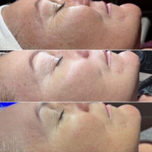 RF Microneedling - What Is It & What Are the Benefits_