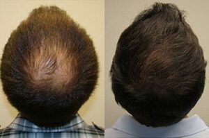 Shedding Before and After a Hair Transplant