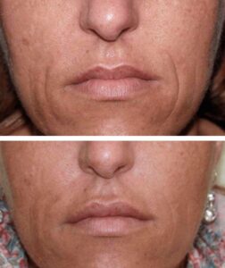 Skin Resurfacing - Microneedling