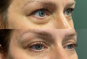 Subnovii before & after