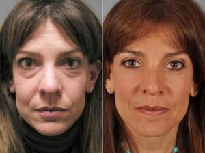 Thyroid Eye Photos _ Philadelphia