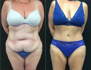 Tummy Tuck (Abdominoplasty) Photos
