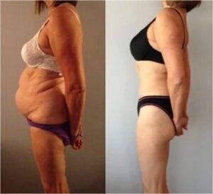 Tummy Tuck Before and After Photo Gallery _ RealSelf