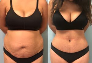 Tummy Tuck before and after photos