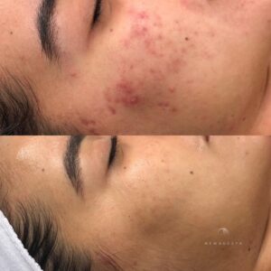#microneedling facial in Montreal