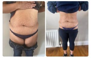 ♥️⭐️ WOW!! most AWESOME COOL-SCULPTING RESULTS!! ⭐️♥️🫶🏼huge inch loss and toned, even skin ♥️💪🏼🫶🏼…